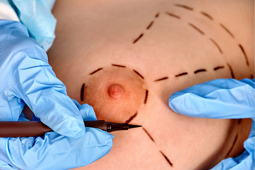 chirurgie-mammaire