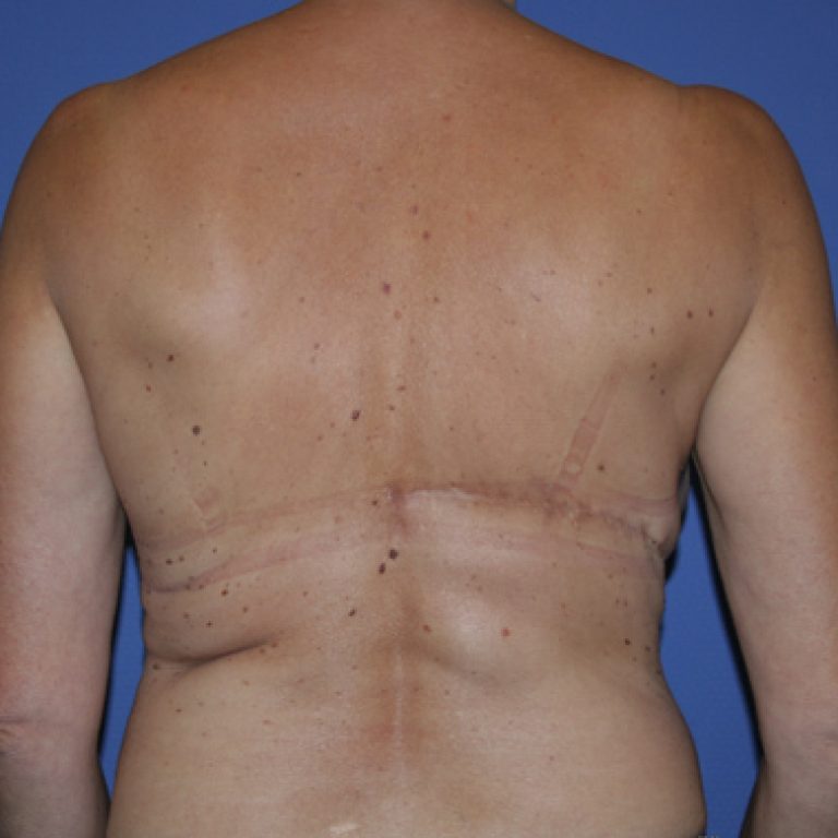 Dr-oukacha-nadia-Reconstruction-par-lambeau-maroc